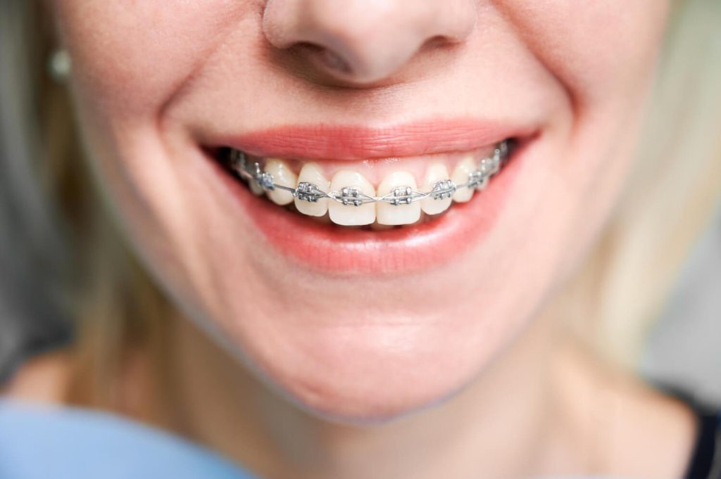 investigații înainte de aparat dentar